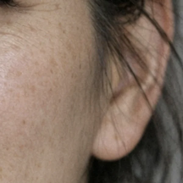 Close-up of the cheek before retouching, with spots and fine lines